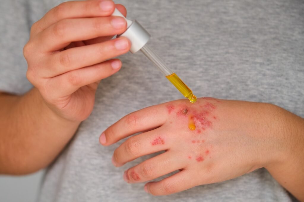 Is castor oil for eczema effective? Benefits & Usage Tips 