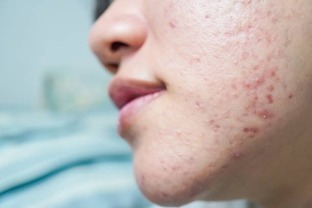 hormonal acne on the jaw