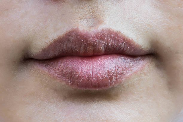 Dry Skin and Lips - Signs of dehydration
