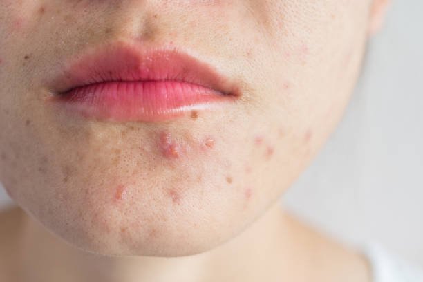 Dealing with Hormonal Acne? Here’s How to Tackle Breakouts at Any Age
