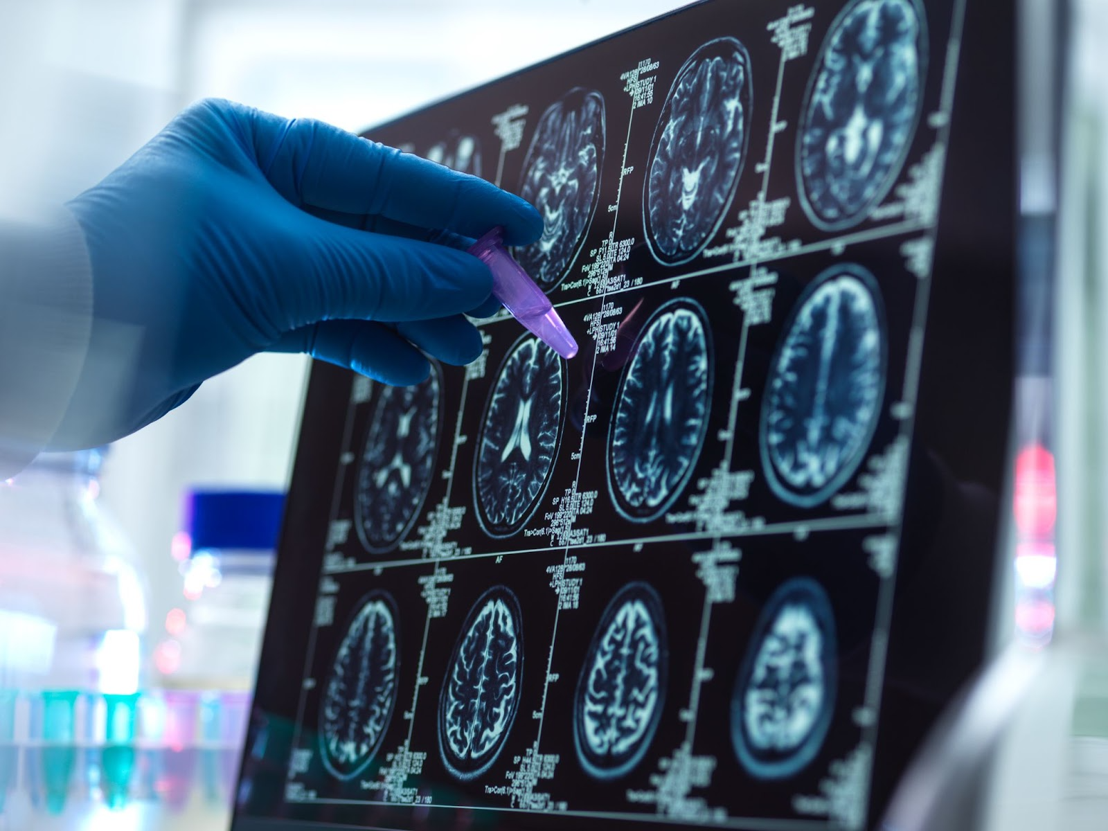 Is Multiple Sclerosis Hereditary? A Simple Guide to Understand