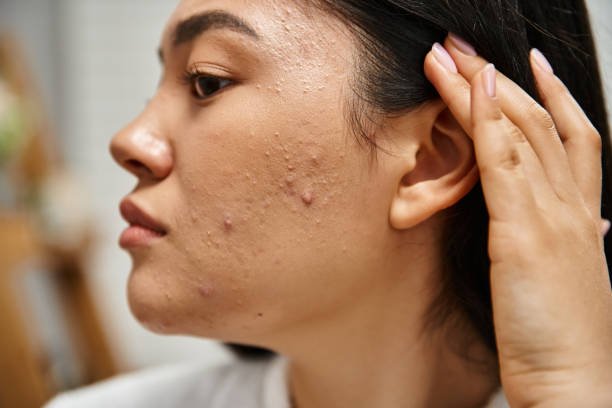 Perimenopause Acne -Functional medicine clinic, Houston, Tx