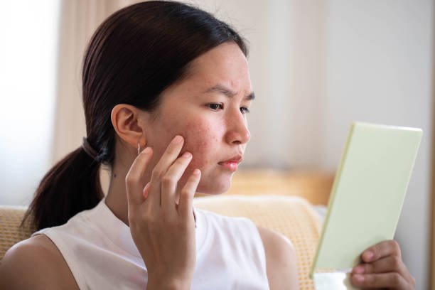 Adult Acne Causes: Why It Keeps Coming Back and Root Cause Fixes